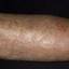 169. Venous Eczema on Legs Pictures