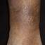17. Venous Eczema on Legs Pictures