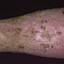 170. Venous Eczema on Legs Pictures