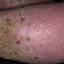 172. Venous Eczema on Legs Pictures