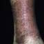 173. Venous Eczema on Legs Pictures