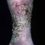 18. Venous Eczema on Legs Pictures