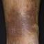 19. Venous Eczema on Legs Pictures