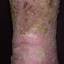 2. Venous Eczema on Legs Pictures