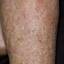 20. Venous Eczema on Legs Pictures