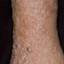21. Venous Eczema on Legs Pictures