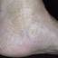 22. Venous Eczema on Legs Pictures