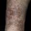 23. Venous Eczema on Legs Pictures