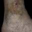 26. Venous Eczema on Legs Pictures
