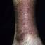 28. Venous Eczema on Legs Pictures