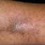 29. Venous Eczema on Legs Pictures