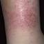 3. Venous Eczema on Legs Pictures