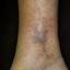 30. Venous Eczema on Legs Pictures