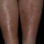 31. Venous Eczema on Legs Pictures