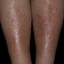 32. Venous Eczema on Legs Pictures