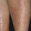 34. Venous Eczema on Legs Pictures