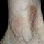 35. Venous Eczema on Legs Pictures
