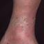37. Venous Eczema on Legs Pictures