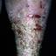 38. Venous Eczema on Legs Pictures