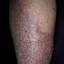 39. Venous Eczema on Legs Pictures