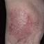 4. Venous Eczema on Legs Pictures