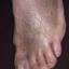 40. Venous Eczema on Legs Pictures