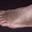 41. Venous Eczema on Legs Pictures