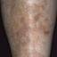 42. Venous Eczema on Legs Pictures