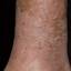 44. Venous Eczema on Legs Pictures