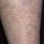 45. Venous Eczema on Legs Pictures