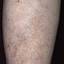 46. Venous Eczema on Legs Pictures