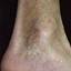 47. Venous Eczema on Legs Pictures