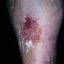 48. Venous Eczema on Legs Pictures