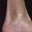 49. Venous Eczema on Legs Pictures