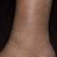 5. Venous Eczema on Legs Pictures