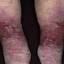 51. Venous Eczema on Legs Pictures