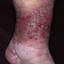 52. Venous Eczema on Legs Pictures