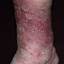 53. Venous Eczema on Legs Pictures