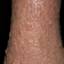 55. Venous Eczema on Legs Pictures