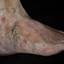 58. Venous Eczema on Legs Pictures