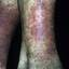 59. Venous Eczema on Legs Pictures