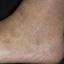 6. Venous Eczema on Legs Pictures