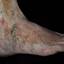 60. Venous Eczema on Legs Pictures