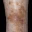61. Venous Eczema on Legs Pictures