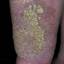 64. Venous Eczema on Legs Pictures