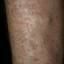 66. Venous Eczema on Legs Pictures