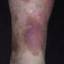 68. Venous Eczema on Legs Pictures