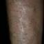 7. Venous Eczema on Legs Pictures