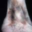 70. Venous Eczema on Legs Pictures