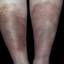71. Venous Eczema on Legs Pictures